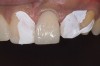 Figure 13  Layering enamel shade to full contour.