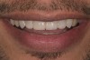 Figure 14  Postoperative smile.