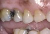 (Figure 4.) Gingival recession with exposed root surfaces are susceptible to dentinal hypersensitivity facial surfaces of maxillary teeth with recession with symptoms of dentin hypersensitivity.