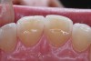 (4.) CR/MIP discrepancies are very common and are major factors leading to excessive tooth-to-tooth abrasion.