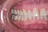 (5.) The anterior teeth must have sufficient lingual contour to allow immediate disclusion of the posterior teeth.