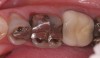 (7.) “Ditching” from GERD around existing restorations may be noted upon examination.