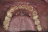 (16.) Preoperative mandibular, occlusal view.