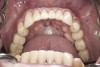 (42.) Postoperative mandibular occlusal view. Note the composite tops on teeth Nos. 28 through 31.