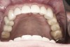 (41.) Postoperative maxillary occlusal view. Note the composite tops on teeth Nos. 12 through 14.