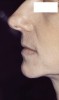 Figure 2. Profile of a 36-year-old woman without dentures.