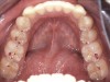 Figure 4. Occlusal contacts occur generally on the posterior teeth, most often on the first molars, followed by the second molars and premolars.