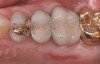 Figure 5. The second premolar and both molars were constructed in centric relation. The crowns were cemented because the patient said they were comfortable. There are no contacts on the second molar and minimal contacts on the first molar and second premolar crowns.
