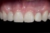 (6.) Six years post-operatively. Chipping noted on resin-based composites associated with nail biting habit. Bridge had not loosened.