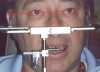 Figure 11. The anterior bar of the facebow is not parallel to the interpupillary line. This is not uncommon, as the interpupillary line often varies somewhat from the maxillary anterior plane of occlusion. A decision to alter an anterior plane would be made depending on the current esthetics and the incisional efficiency of the path of closure.