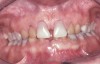 Figure 6. The patient is congenitally missing the maxillary lateral incisors and canines and all lower incisors and canines, causing concerns about esthetics. The maxillary laterals and canines and mandibular canines have been bonded with composite.