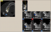 (1.) Limited field of view, high resolution (0.125 mm voxel size) scan of the right maxilla for the assessment of tooth #2, which was symptom- atic. Note the thin radiolucent line indicating a longitudinal fracture.