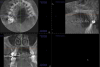 (2.) CBCT orthogonal sections showing severe patient motion. Note the double margin of the maxilla and mandible, especially in the sagittal section (upper left). This scan has to be retaken.