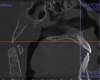 (5.) Sagittal orthogonal section of the maxillary midline showing a developing mass in the posterior pharyngeal wall. This is posterior pharyngeal tonsilar hypertrophy (hypertrophic ad- enoids), which is causing significant narrowing of the airway at the level of the naso-pharynx.