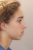 (10.) Profile after 20 months of orthodontic treatment demonstrating even more nasal growth and resulting in the increased facial convexity that was expected.