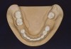 Figure 16 THROUGH 19. Complete full mouth wax-ups after final determination of 3D VDO.