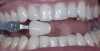 (2.) Preoperative whitening photograph with shade tab that matches pre-existing color.