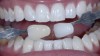 (6.) The teeth of the patient shown in Figure 1 and Figure 2 have whitened all the way to the 010 whitening shade tab.