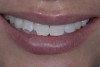 (9.) After completion of whitening and ready for the composite restorations, which will address the fracture lines and the multicolored pre-existing condition.