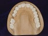 Figure 16 THROUGH 19. Complete full mouth wax-ups after final determination of 3D VDO.