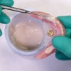 (6.) Acrylic resin being placed over the occlusal surfaces of the mandibular denture teeth.