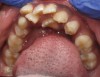 (2.) In children, mouth breathing with low tongue posture can result in narrow maxillary arches, dental crowding, tongue scalloping, and anterior open bites. Images courtesy of Kevin Boyd, DDS, MSc.