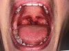 (4.) Enlarged tonsils and adenoids are commonly accompanied by bruxism. Figure 5 courtesy of Kevin Boyd, DDS, MSc.