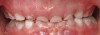 (5.) Enlarged tonsils and adenoids are commonly accompanied by bruxism. Figure 5 courtesy of Kevin Boyd, DDS, MSc.