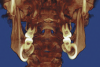 Figure 4A  Coronal section of 3D tomograph revealing axial alignment of posterior teeth. A) Dental alignment does not allow occlusal forces to be directed down long axis of teeth. Maxillary teeth had been tipped to the buccal to compensate for the transverse discrepancy. B) Teeth are positioned to allow occlusal forces to be directed down long axis of teeth.