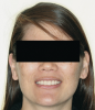 Figure 6  Facial esthetics starts with the maxillary incisal edges following the lower lip in the smile, but involves much more.