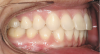 Figure 8  Intraoral view of the occlusion of patient from Figure 7 after retreatment. The occlusion is adequate to finish with equilibration.