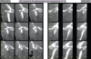 Figure 9B An example of orthodontic and orthognathic surgery being performed without adequate goals. B) Tomographic evidence of degenerative joint disease and condyles positioned distal to the center of the fossa.