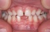 (4.) Patient presents bilateral crossbite and significant attrition. Father assists in retraction.