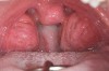 (5.) Class 3 tonsils and an enlarged uvula. The impact on the child rather than the physical size should be key for surgical intervention.