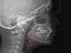 (6.) Radiographic evaluation of tonsils. Intraoral examination may not clearly portray the volume of tissue.