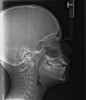 (17.) Moderate adenoid swelling and significant tonsillar obstruction.