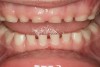 (19.) Five-year-old child with significant attrition. Mother reports a history of sleep bruxism (Case provided by Kathy French, DDS).