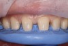 (8.) Showing the gingival and incisal embrasure opening for the desired porcelain veneers. This aspect of preparation still needs to be tested and verified in the provisional stage.