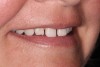 (14.) The preoperative right smile.