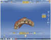 Figure 2 A scan was taken of the tooth No. 9 preparation and added into the old scan in the “Upper Arch” folder.