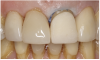 Figure 6 The veneer fit was verified intraorally, after which it was polished.