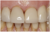 Figure 7 The veneer was seated using dental adhesive and resin cement.