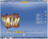 Figure 11 After the patient closed into maximum intercuspation and the bite relation captured in the “Buccal Bite” folder, the software compiled the three scans to mimic maximum intercuspation.