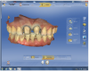 Figure 15 After scanning the “Buccal Bite,” the software compiled the three scans to mimic the patient’s maximum intercuspation.