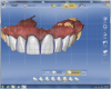 Figure 23 The crown designs were modified using different CAD software tools to create ideal embrasures, line angles, and contacts.