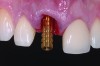 (6.) Temporary cylinder attached to immediate implant replacing tooth No. 8.