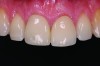 (8.) Postoperative appearance of immediate implant and provisional replacing tooth No. 8 shown 6 weeks following procedure.