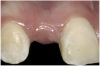 Figure 2  Congenitally missing maxillary right lateral incisor.