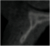 Figure 3  CBCT sagittal view. Note the extent of alveolar ridge deficiency.