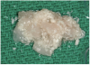 Figure 4  rhBMP-2/ACS plus mineralized allograft.